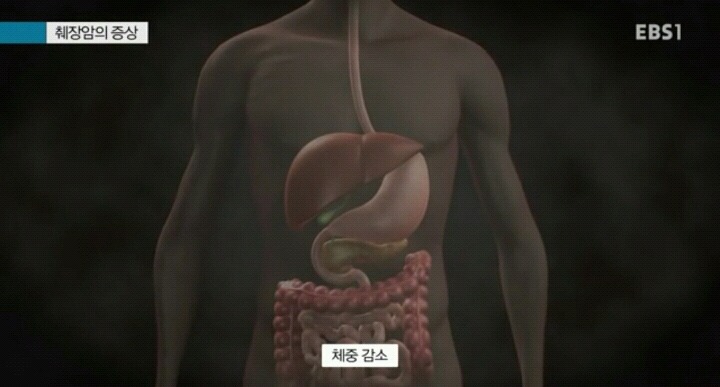 췌장암이 최악의 암으로 불리는 이유.jpg | 인스티즈