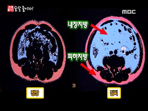 침묵의 암살자 뱃속의 시한폭탄 내장지방의 위험성 | 인스티즈
