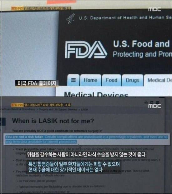 라식 라섹수술을 하면 안되는 이유....jpg | 인스티즈